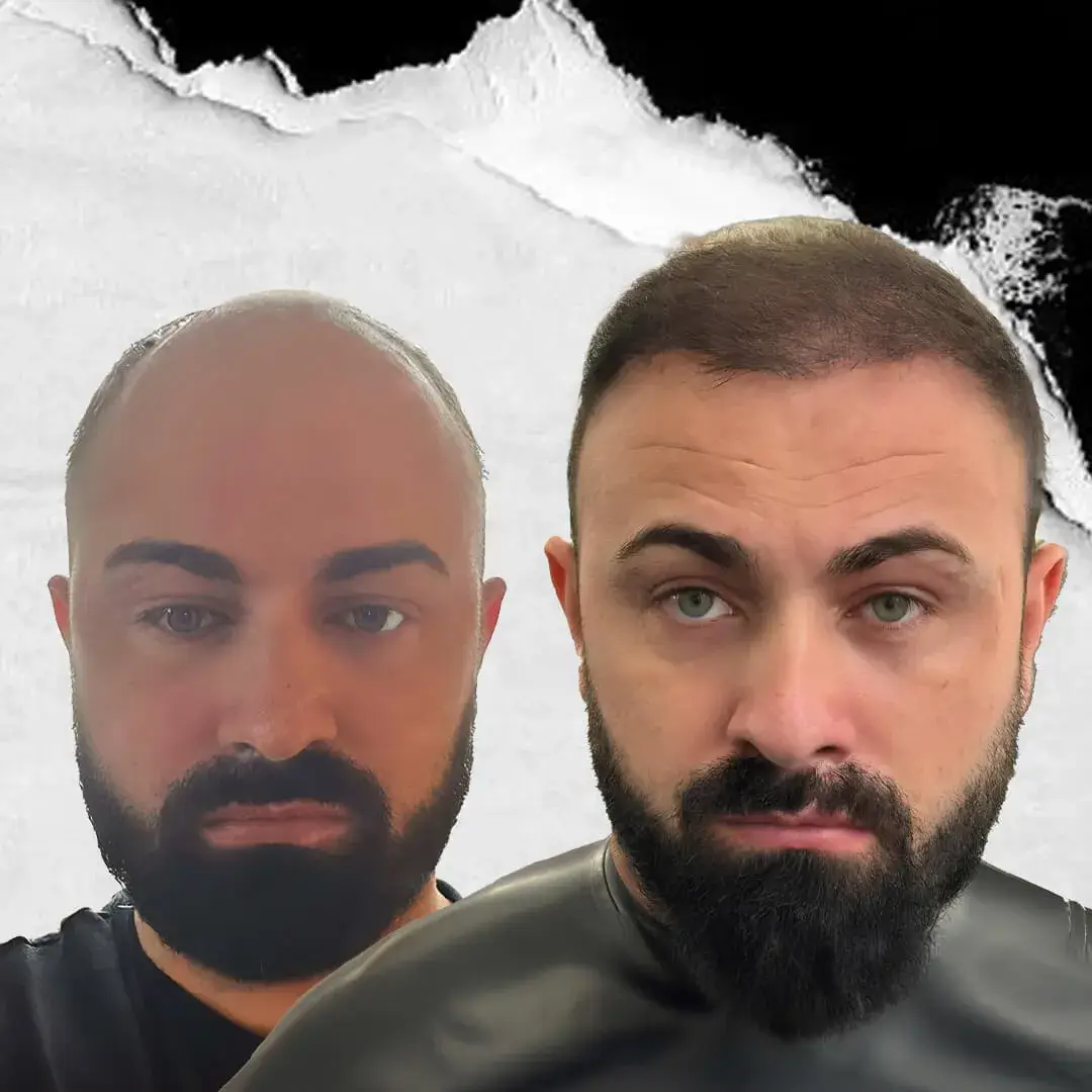 Stem Cell Hair Transplant in Istanbul, Turkey by International Plus