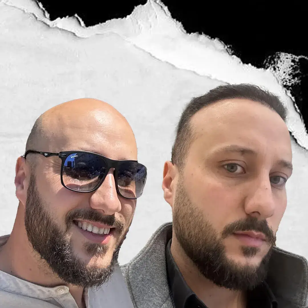 Stem Cell Hair Transplant in Istanbul, Turkey by International Plus