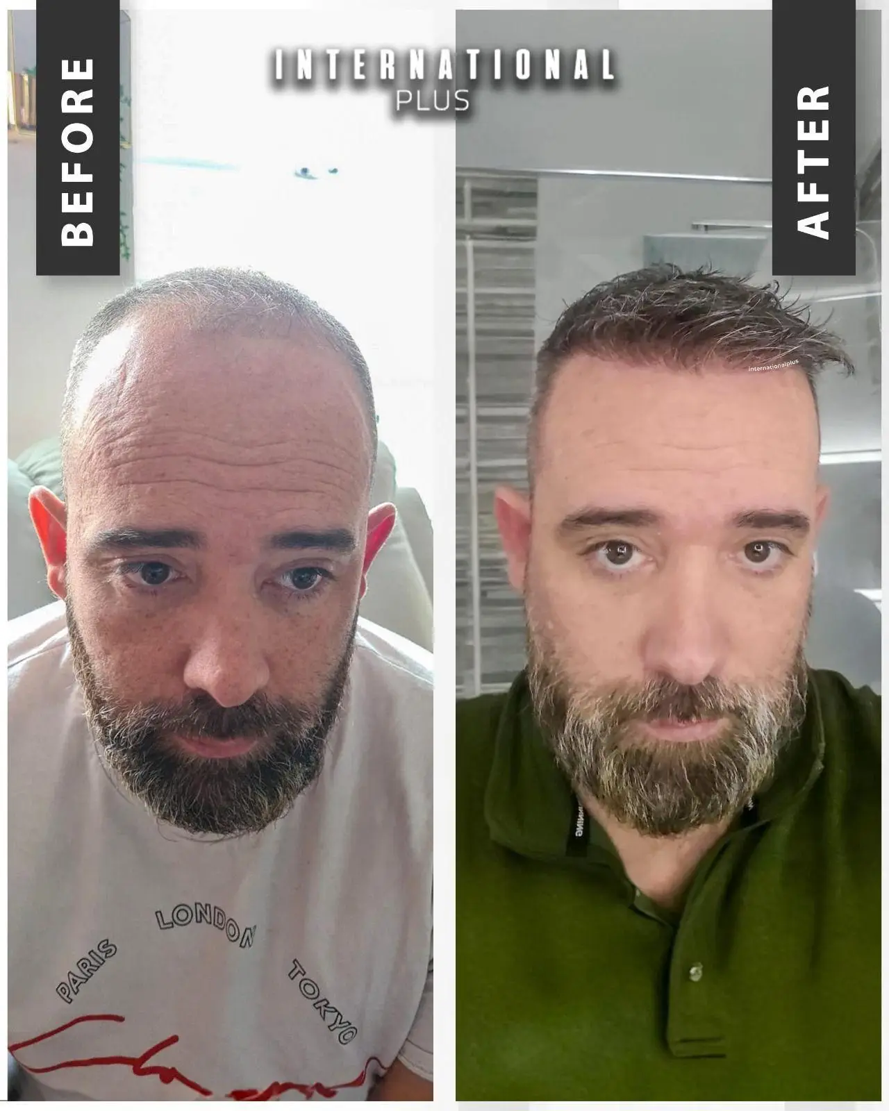 DHI (Direct Hair Implantation) Hair Transplant in Istanbul, Turkey by International Plus
