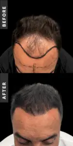 Hair Transplant in Istanbul, Turkey by International Plus