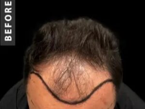 Hair Transplant in Istanbul, Turkey by International Plus — Hair Restoration Surgery in Turkey