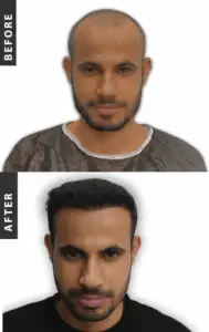 Stem Cell Hair Transplant in Istanbul, Turkey by International Plus