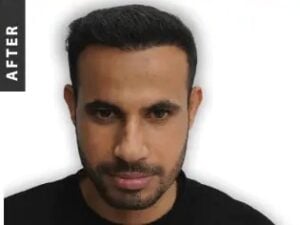 Stem Cell Hair Transplant in Istanbul, Turkey by International Plus — Hair Restoration Surgery in Turkey