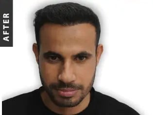 Stem Cell Hair Transplant in Istanbul, Turkey by International Plus — Hair Restoration Surgery Procedure in Turkey