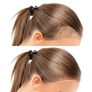 Woman Hair Transplant in Istanbul, Turkey by International Plus