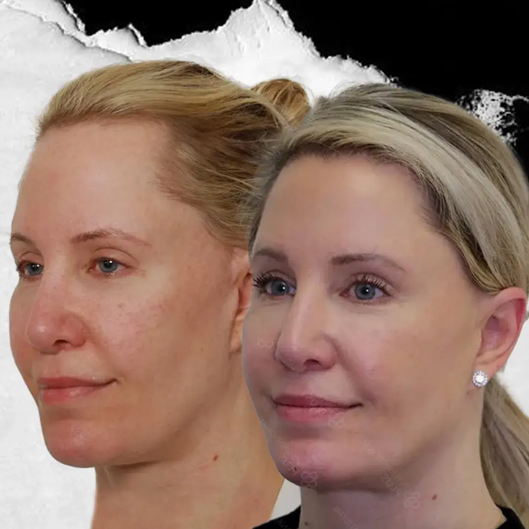 Woman Hair Transplant in Istanbul, Turkey by International Plus