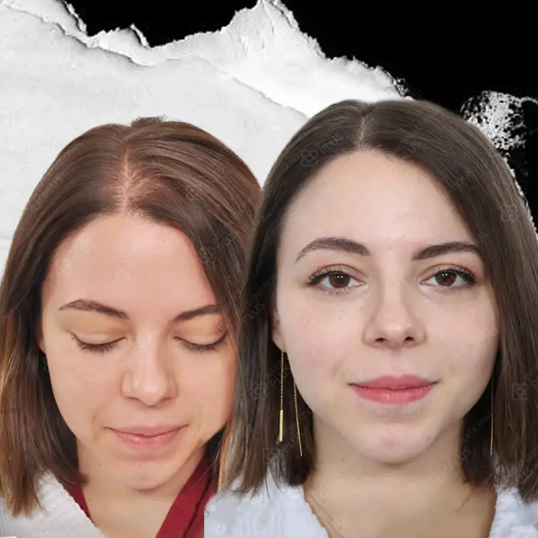 Woman Hair Transplant in Istanbul, Turkey by International Plus