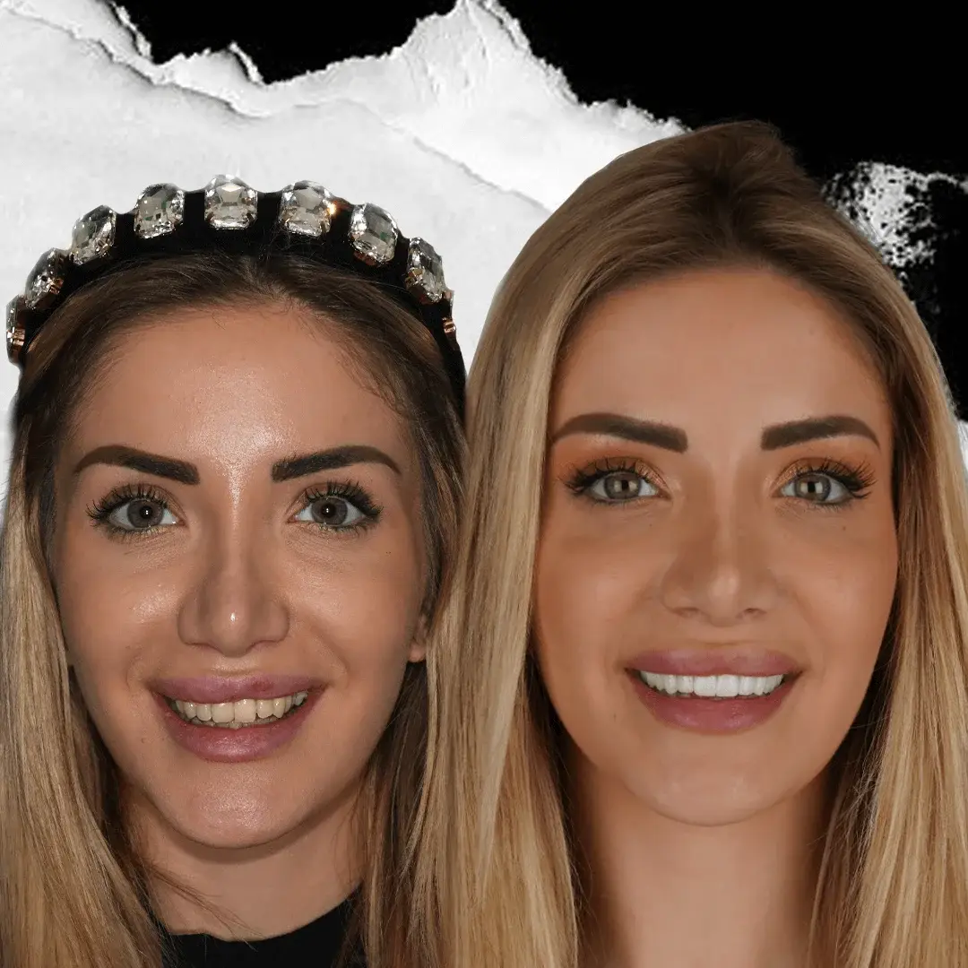 Dental Crowns in Istanbul, Turkey by International Plus