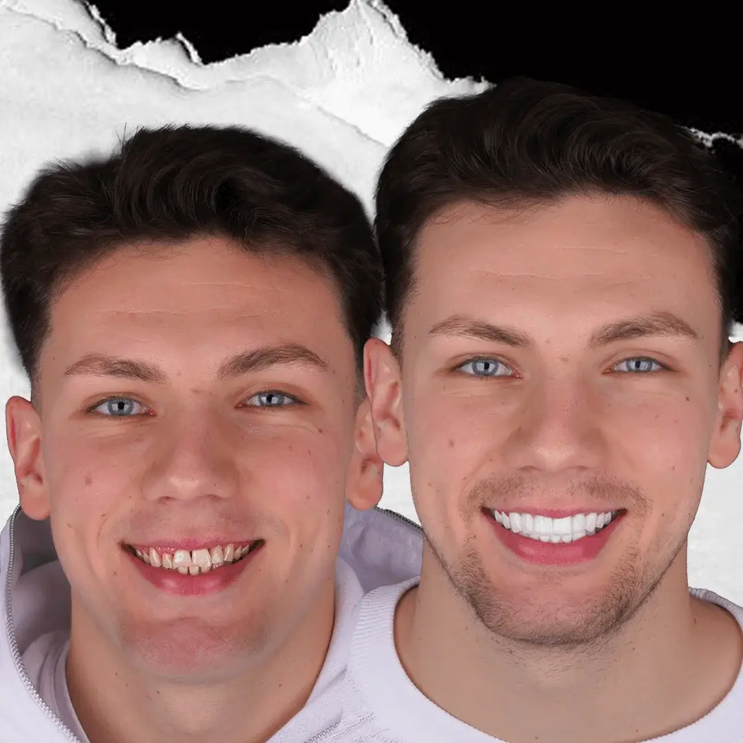 Dental Crowns in Istanbul, Turkey by International Plus