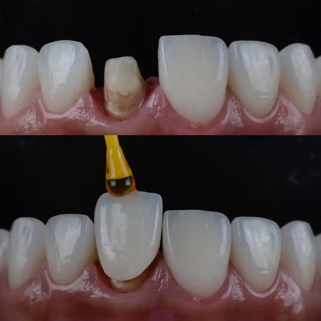 Dental Crowns in Istanbul, Turkey by International Plus