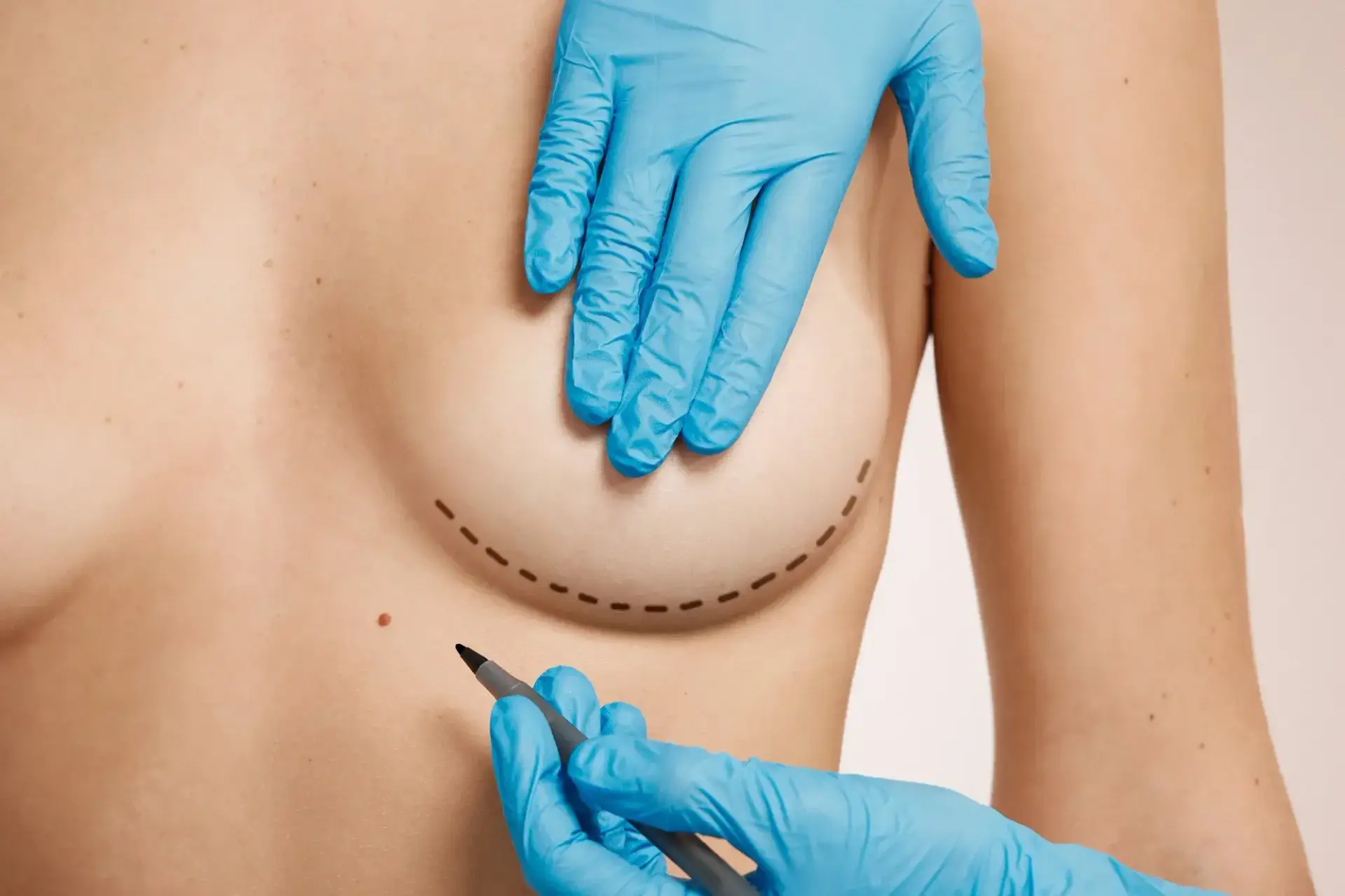best country for breast augmentation