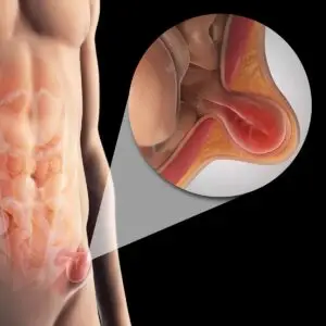 Inguinal Hernia Repair Clinics and Procedures Abroad