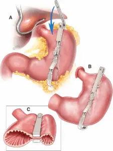 Gastric Clip Clinics and Procedures Abroad