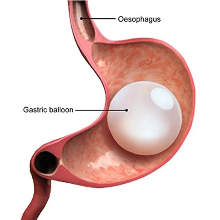 Gastric Balloon in Istanbul, Turkey by International Plus