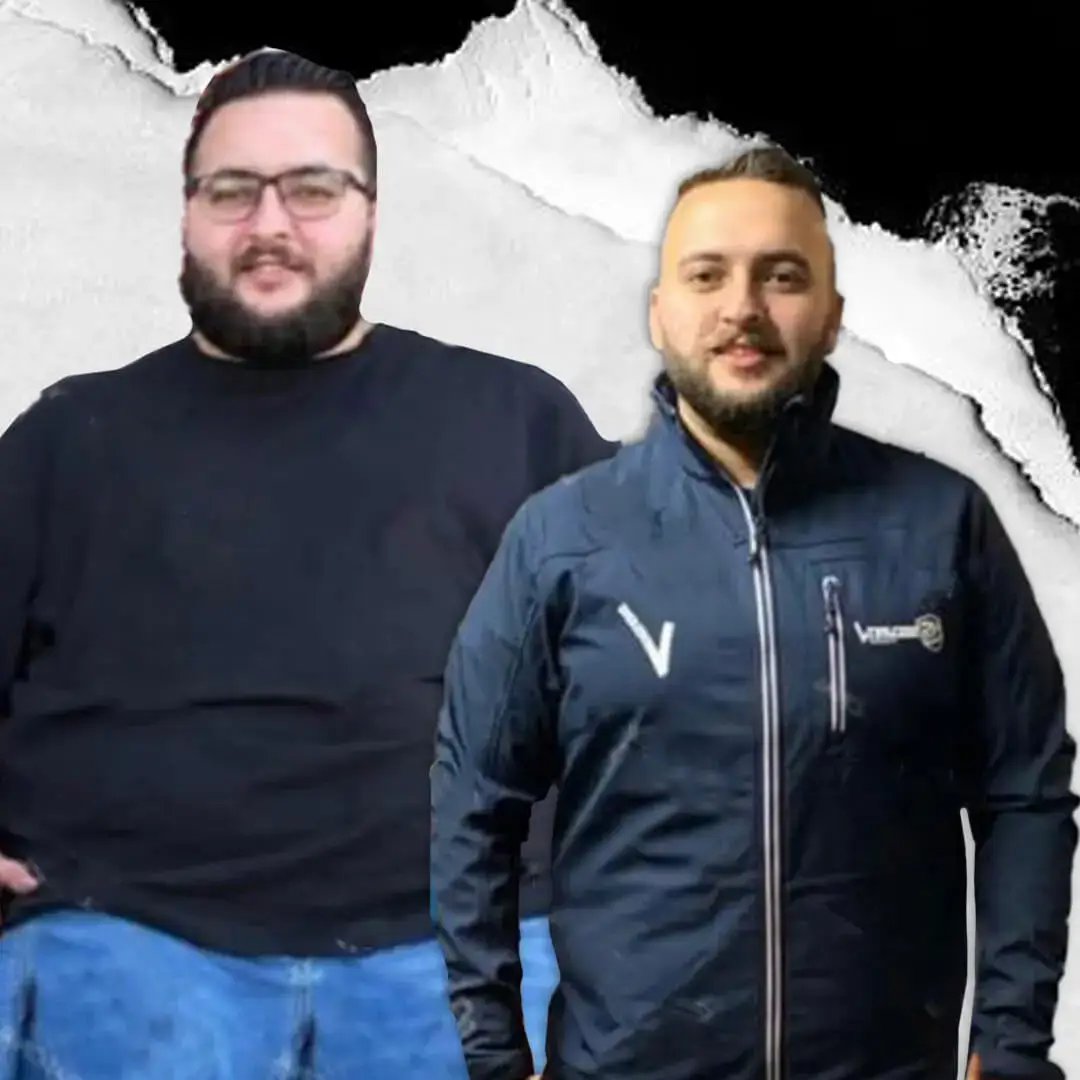 Gastric Sleeve in Istanbul, Turkey by International Plus