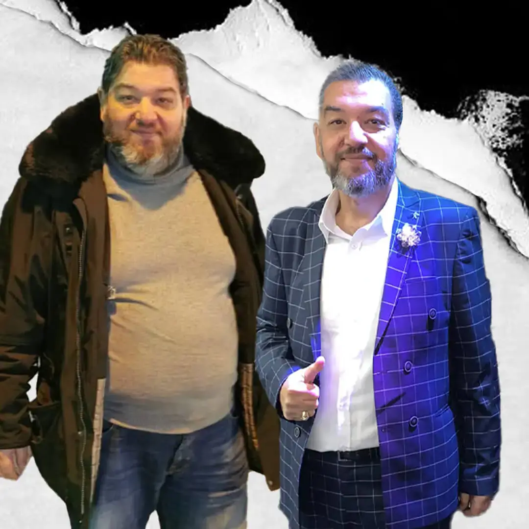 Gastric Sleeve in Istanbul, Turkey by International Plus