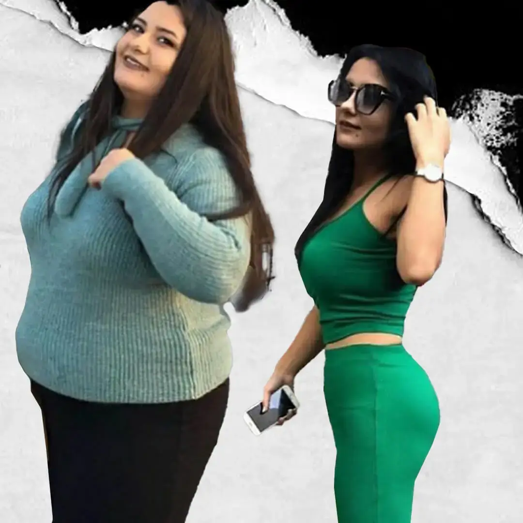 Gastric Sleeve in Istanbul, Turkey by International Plus
