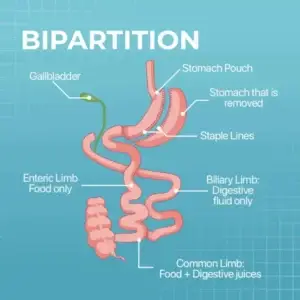 Transit Bipartition Clinics and Procedures Abroad