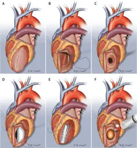 Left Ventricular Aneurysm Repair Clinics and Procedures Abroad