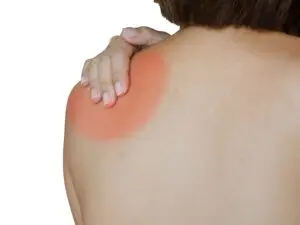 Shoulder Joint Replacement in San Jose, Costa Rica by Clinica Biblica Hospital — Orthopedics in Costa Rica