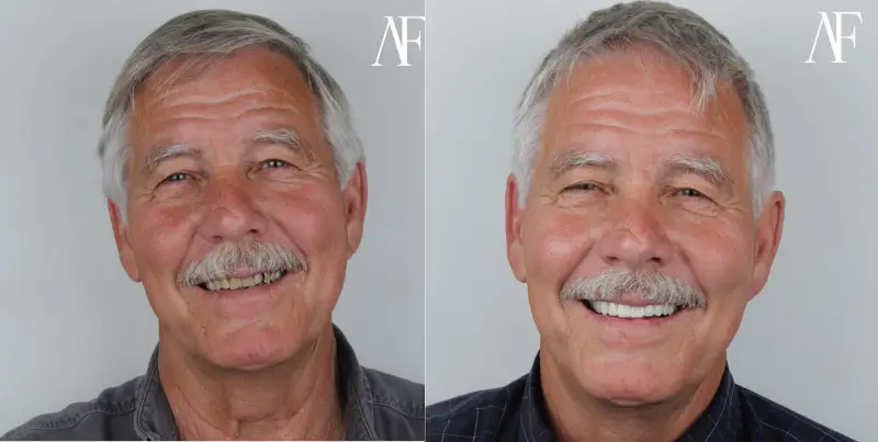 dental implant