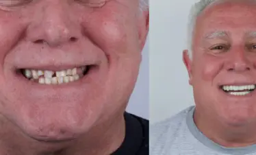dental veneers