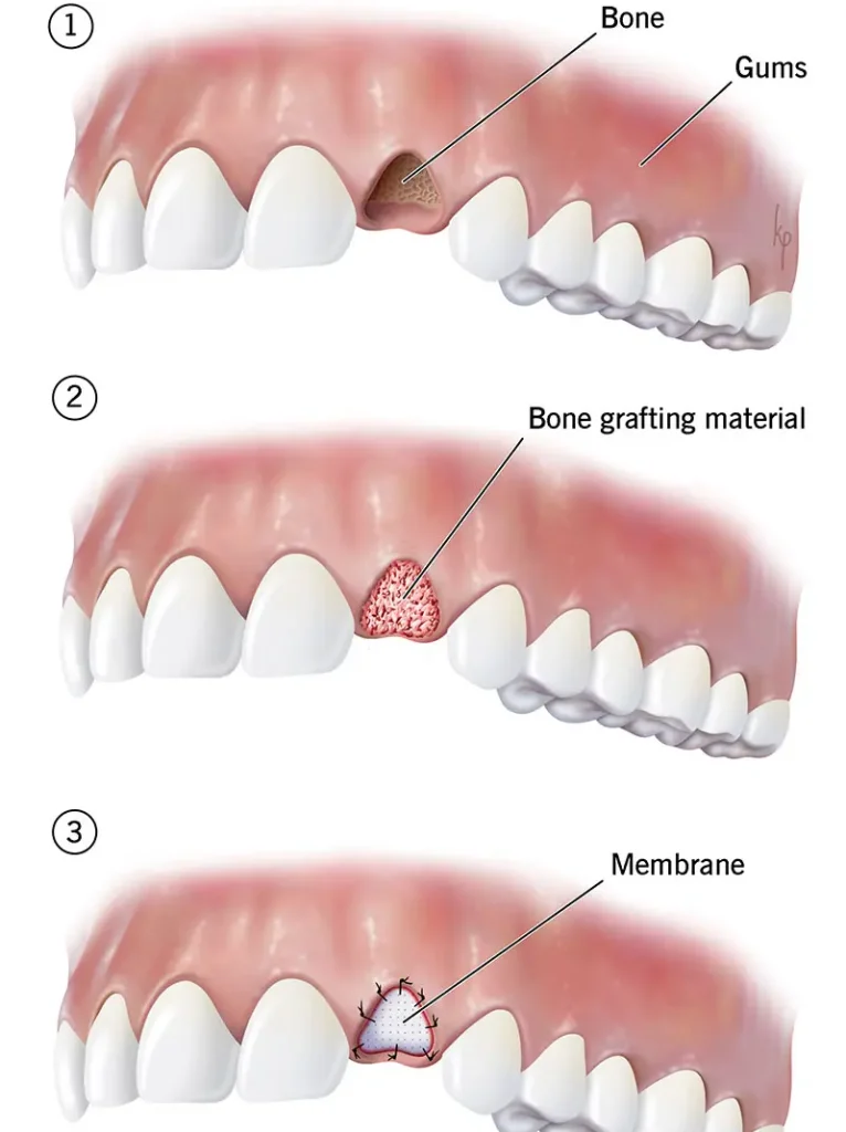 Bone grafting