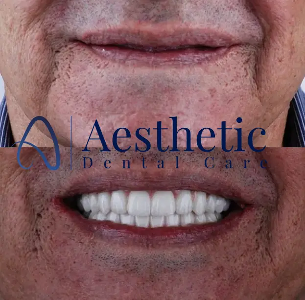 dental implant