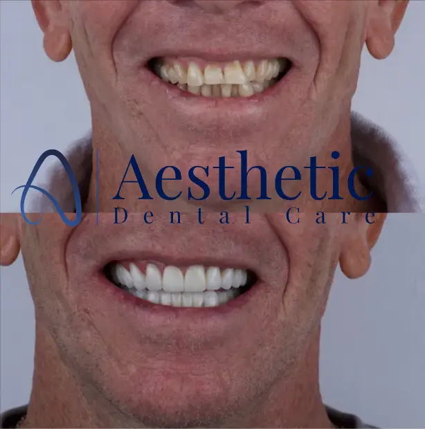 images for before and after Endo Post and Crown build up