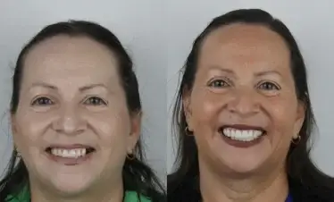 images for Bone grafting before and after