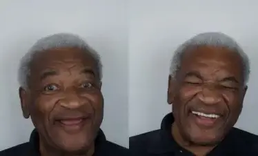 image for Denture before and after