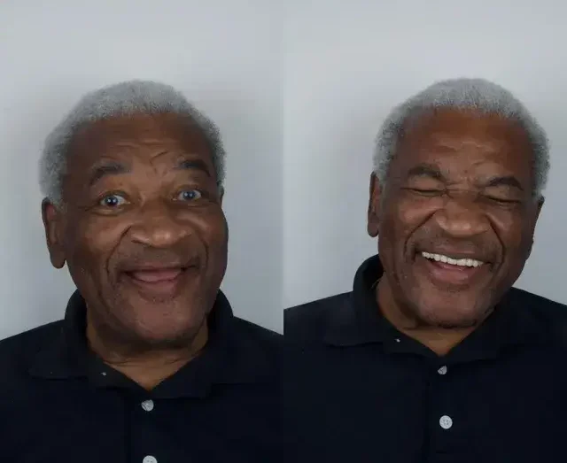 image for Denture before and after