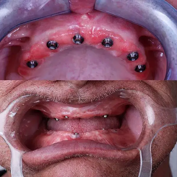 All on 6 dental implant