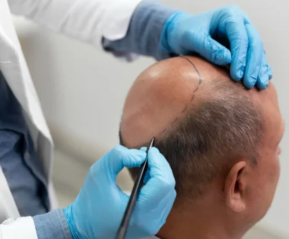 Best Countries for Hair Transplant in the World