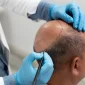Best Countries for Hair Transplant in the World 85x85