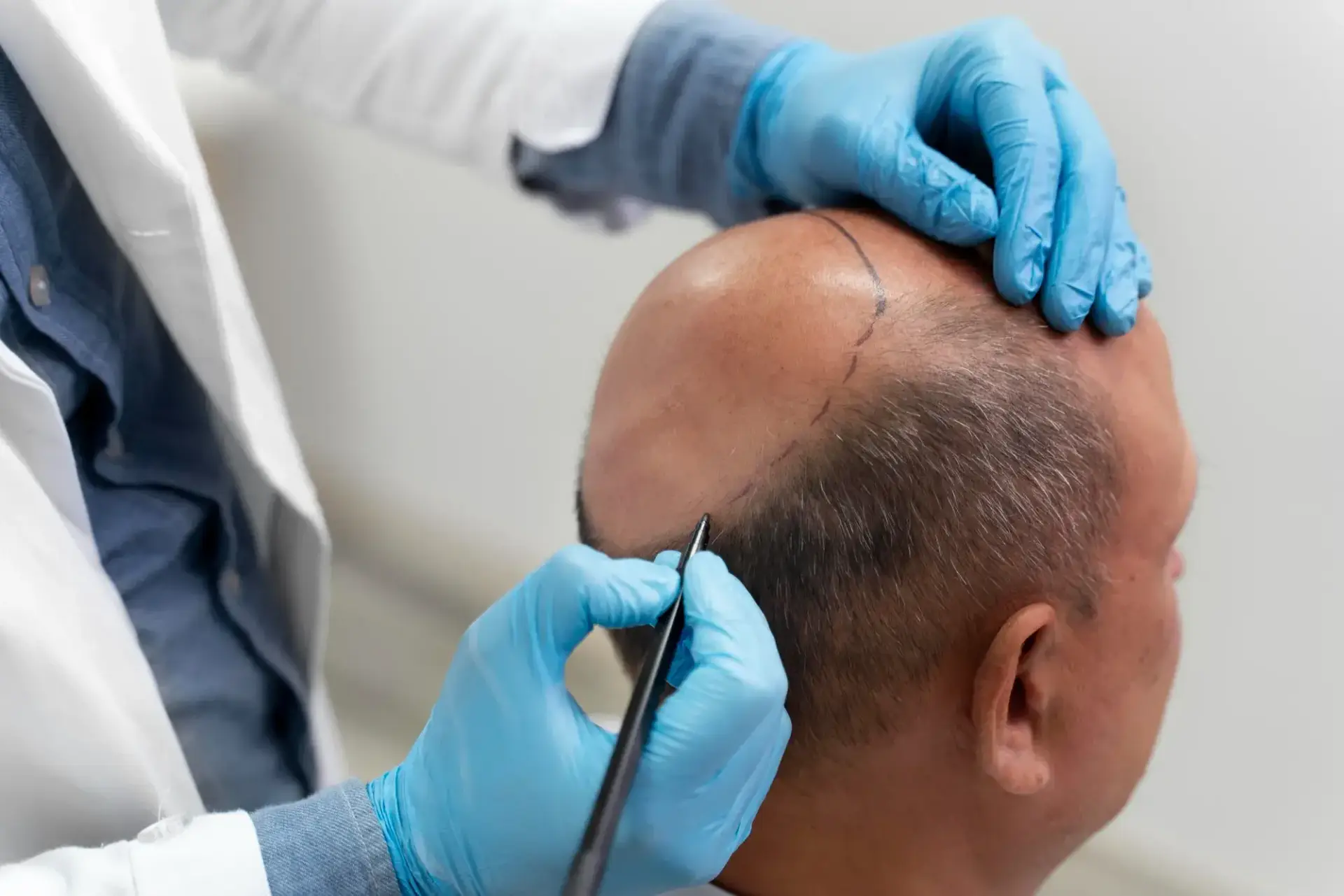 Best Countries for Hair Transplant in the World