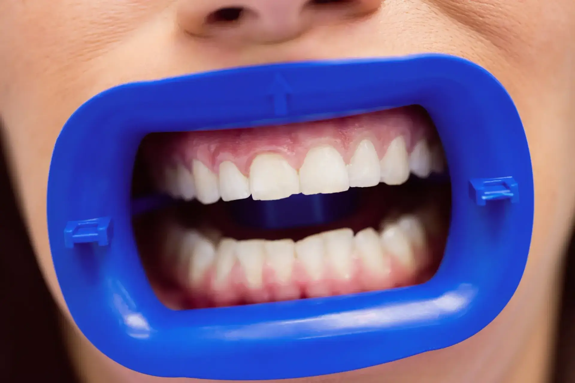 Cost of Full Mouth Dental Implants in Colombia