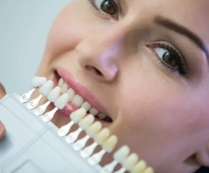 Dental Veneers
