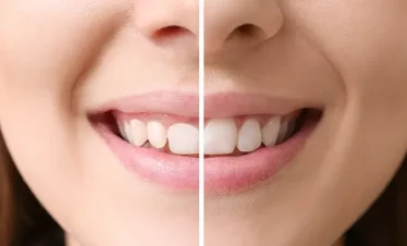 Gingivoplasty