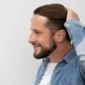 Hair Transplant in Turkey Cost