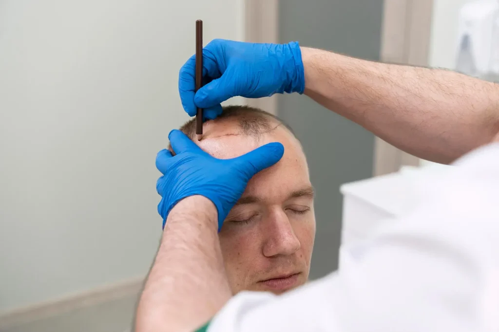 Hair Transplants in Costa Rica Cost