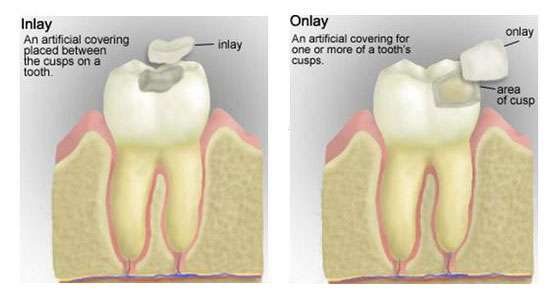 Inlay-and-Onlay