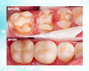 Inlays-Onlays-before-after
