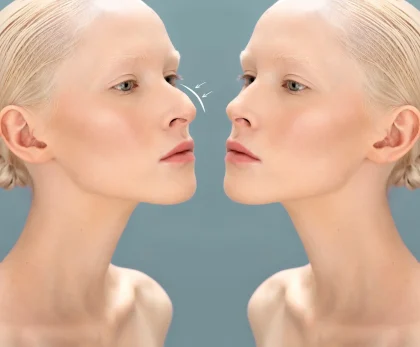 Rhinoplasty in South Korea Cost