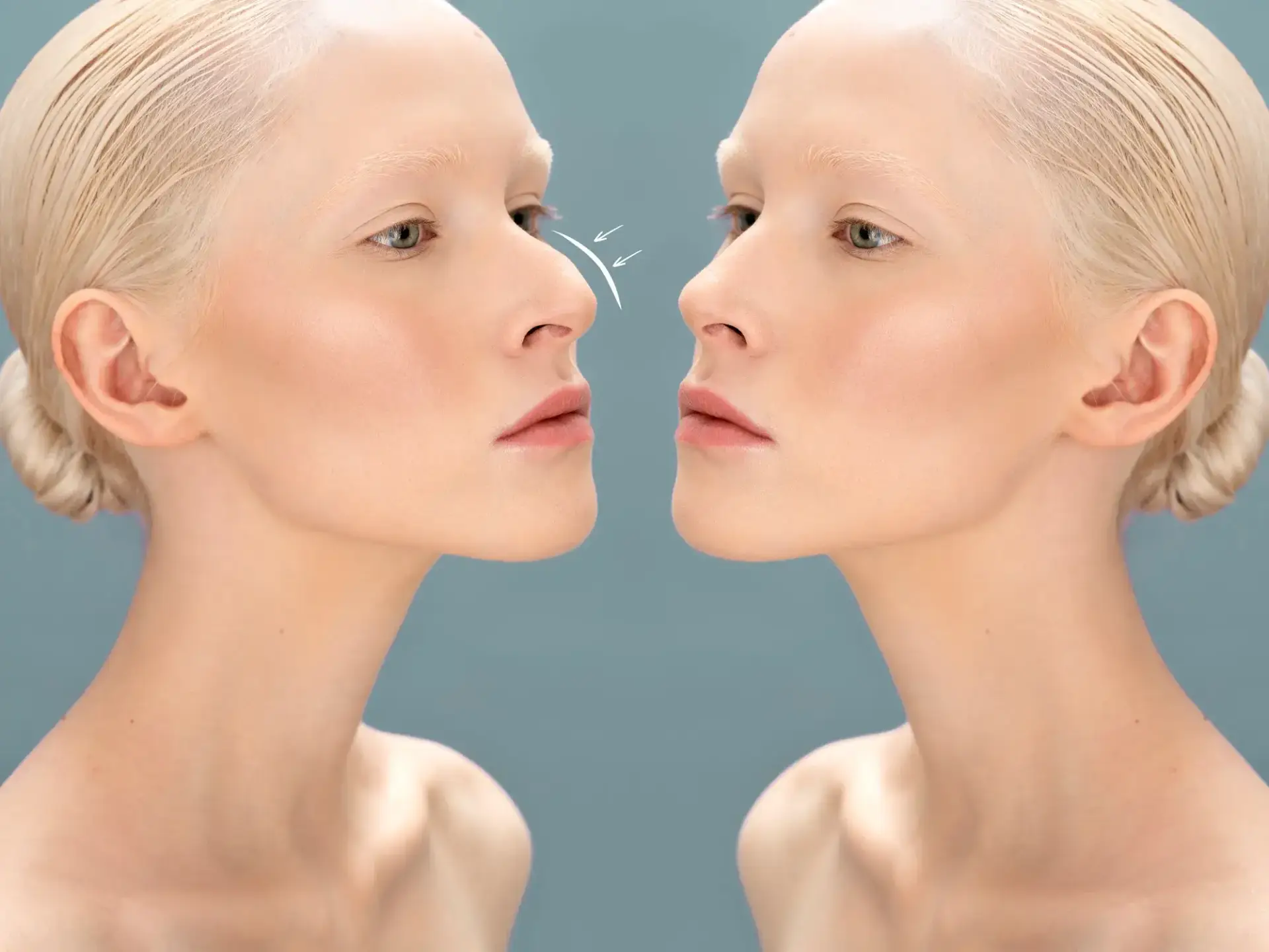 Rhinoplasty in South Korea Cost