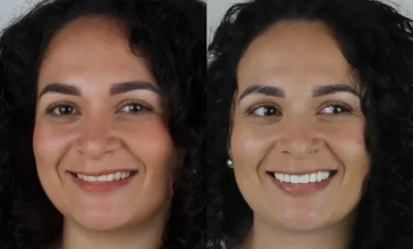 dental veneers