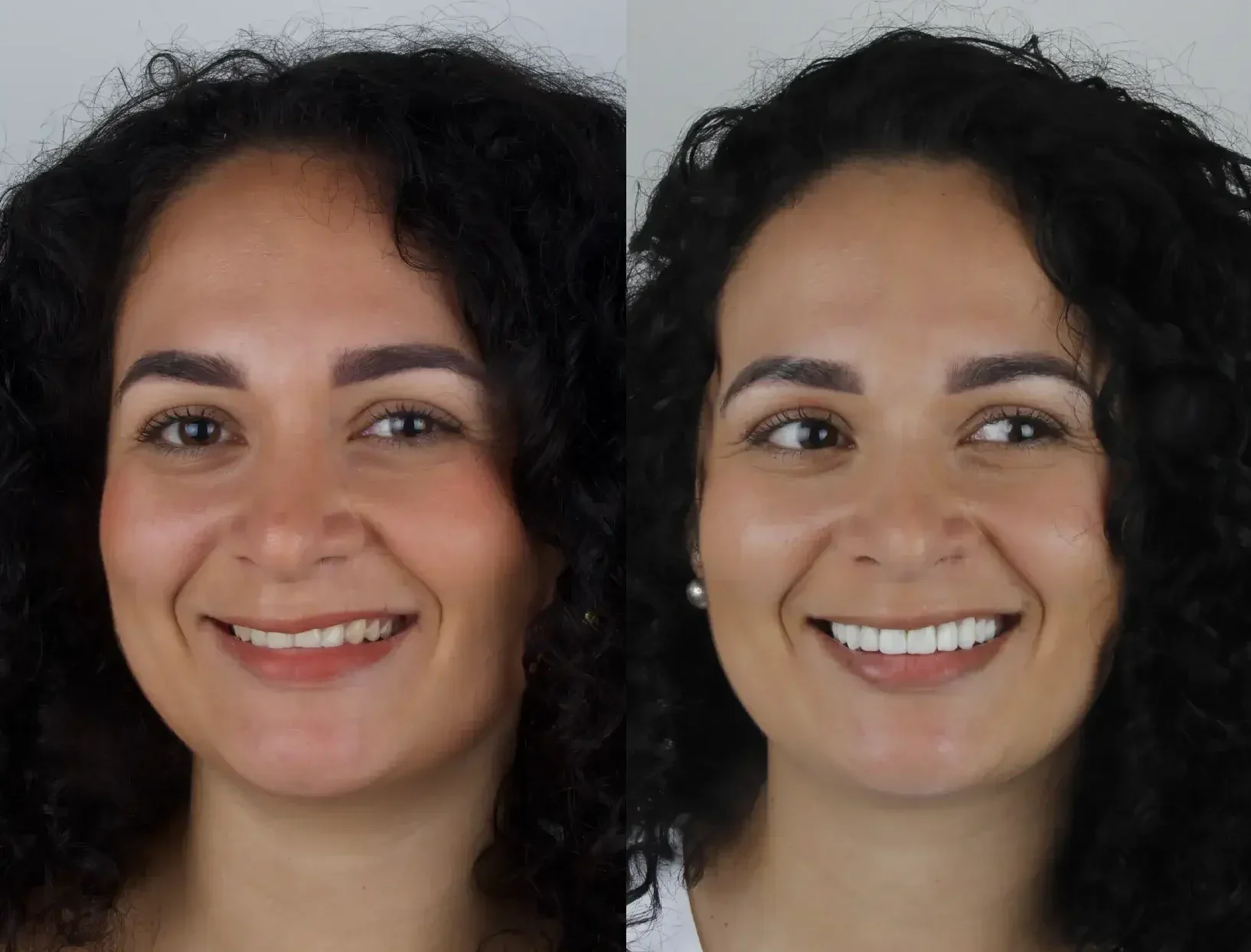 dental veneers