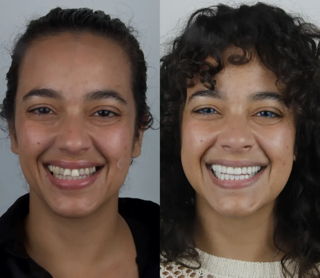 dental crwon