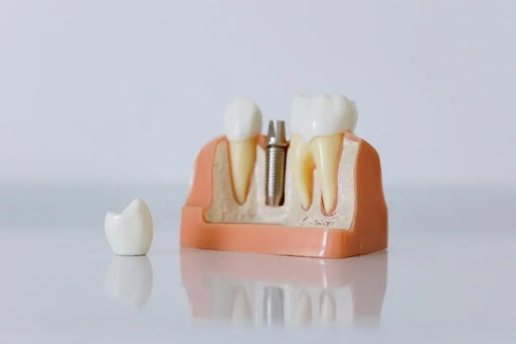 image explaining about all on 4 dental