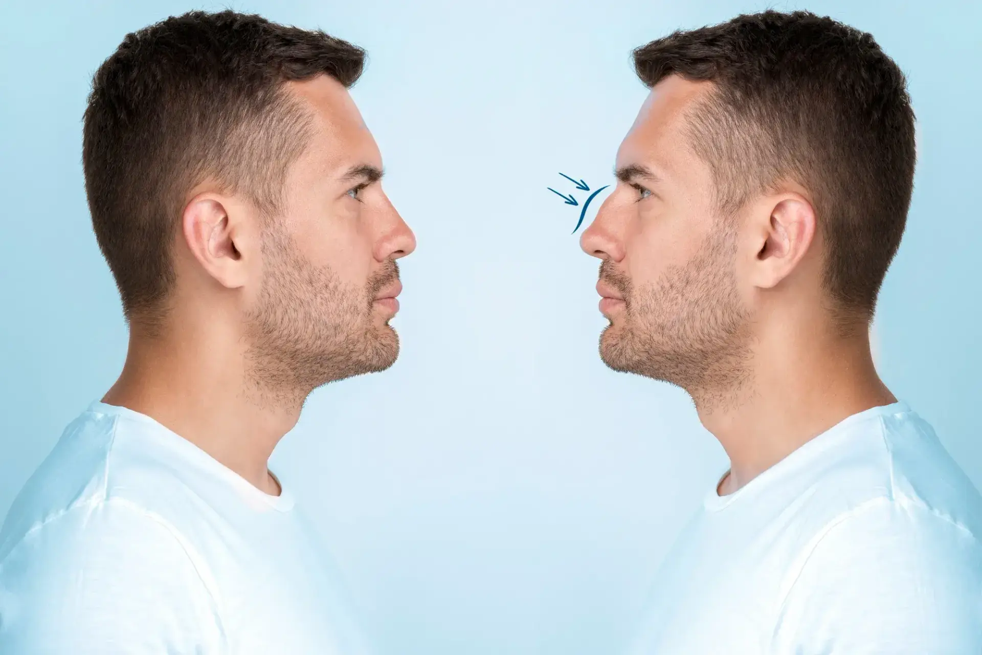 best countries for rhinoplasty